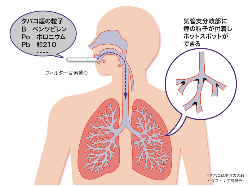 ポロニウム肺ガンイラスト